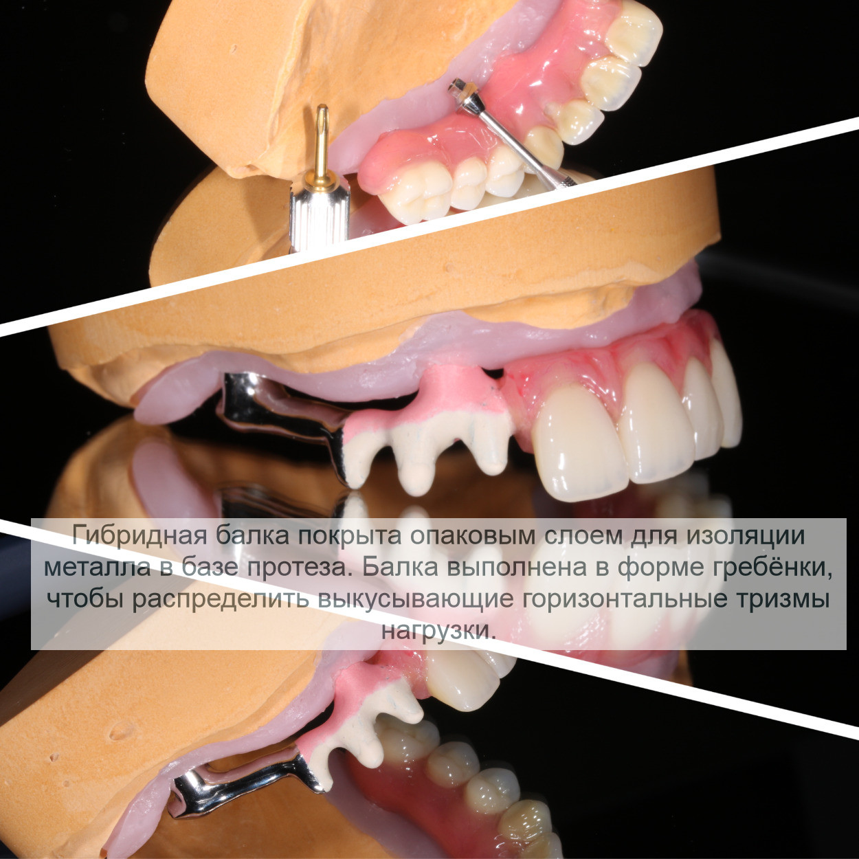керамокомпозито-наполненный протез на литой армированной балке